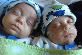 Khó tin: Cặp song sinh chào đời...cách nhau 39 ngày 