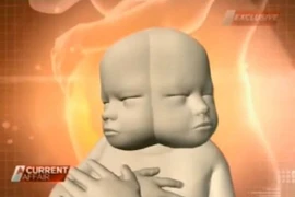  Bào thai có 2 khuôn mặt và 2 bộ não dính liền