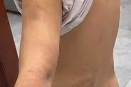 Xác minh hình ảnh bé trai bị đánh tím người tại Hưng Yên