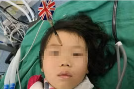 Anh trai lỡ ném phi tiêu trúng mặt em gái