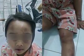 [Tin nhanh sáng 18-7-2021] Tạm giữ vợ chồng cô ruột bạo hành cháu gái 6 tuổi