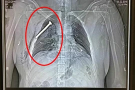 Rùng mình cảnh "bom đinh" tàn phá cơ thể nạn nhân vụ khủng bố ở Bỉ