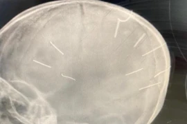 Cơ quan điều tra vào cuộc vụ phát hiện 9 vật thể lạ trong sọ bé gái 3 tuổi hôn mê 