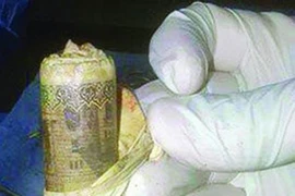 Bọc tiền trong bụng bệnh nhân