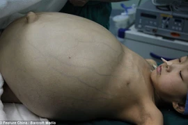 Cận cảnh ca mổ u quái Teratoma khổng lồ ở Trung Quốc