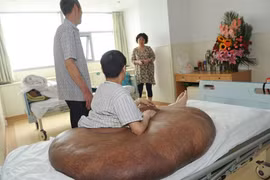 Cắt bỏ thành công “khối u nặng nhất thế giới” 