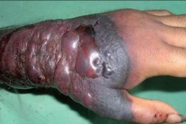 Nhân viên sứ quán Mỹ bị “trả về” vì nghi nhiễm Ebola