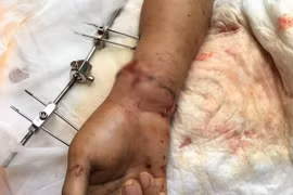 Một công nhân sơ ý để máy trộn bê tông "vặn" đứt cổ tay