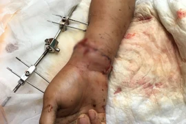 Một công nhân sơ ý để máy trộn bê tông "vặn" đứt cổ tay