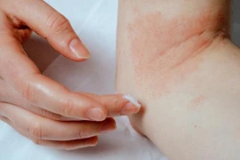 Đình chỉ lưu hành toàn quốc kem bôi ngoài da TRANZAZA do không đạt chất lượng