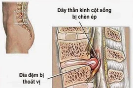 Điều trị thoát vị đĩa đệm cột sống như thế nào