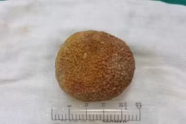 Kỳ lạ: Ông lão có viên sỏi nặng nửa cân trong bàng quang