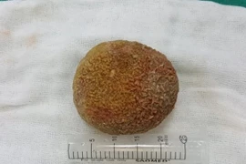 Kỳ lạ: Ông lão có viên sỏi nặng nửa cân trong bàng quang