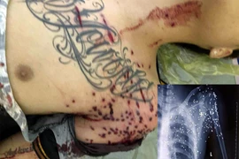 Nam thanh niên bị kẻ lạ mặt dùng súng hoa cải bắn đang nguy kịch