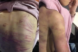 Công an quận Hà Đông điều tra vụ bé gái 15 tuổi nghi bị mẹ đẻ và “người tình” bạo hành