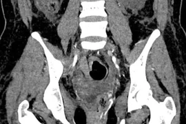 Giành lại sự sống trước “lưỡi hái tử thần” cho sản phụ 33 tuổi