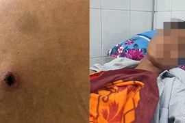 Bị bắn trúng bả vai khi đi ăn cháo đêm