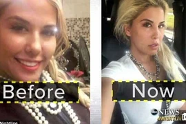 Rộ mốt phẫu thuật giống ái nữ nhà Trump