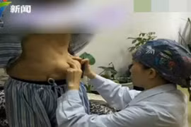 Nhập viện vì "ngực giả"... trôi xuống bụng