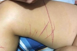 Truy tìm kẻ rạch đùi, chân nữ sinh tại Hà Nội