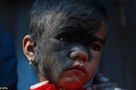 Lông tóc mọc kín nửa mặt bé gái 9 tuổi