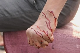 Kỳ quặc chuyện dùng dao lam rạch người để chữa bách bệnh