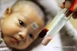 Nồng độ vitamin D thấp và nguy cơ thiếu máu ở trẻ