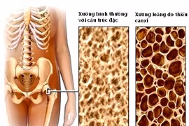 Tuân thủ 5 bước để phòng ngừa loãng xương