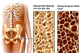 7 cách phòng ngừa loãng xương