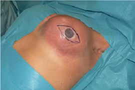 Muỗi đốt làm vỡ ngực giả