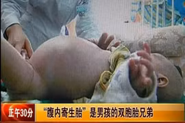 Bé trai 2 tuổi “đẻ” ra người anh em sinh đôi