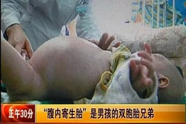 Bé trai 2 tuổi “đẻ” ra người anh em sinh đôi