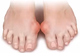 Các yếu tố gây bệnh gút