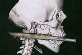 Bị lao đâm xuyên cuống họng vẫn sống sót