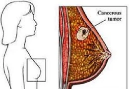 Thuốc mới cho thấy triển vọng điều trị ung thư vú 