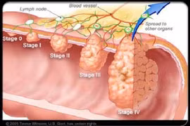 Quy tắc giảm nguy cơ ung thư đại trực tràng