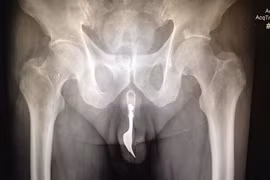 Cụ ông "tự sướng" bằng cách nhét cả chiếc dĩa vào “cậu nhỏ”