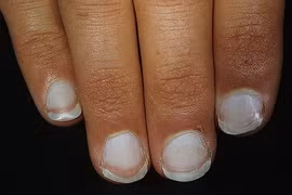 Móng tay nói gì về sức khỏe của bạn?