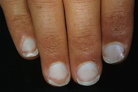 Móng tay nói gì về sức khỏe của bạn?