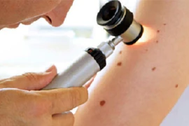 Bạn có nguy cơ bị u hắc tố?