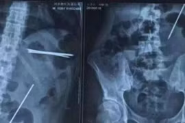 Nuốt đinh sắt để... gây ấn tượng 