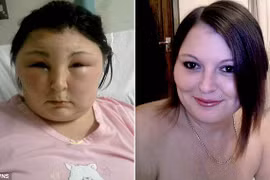 Tự nhuộm tóc khiến mắt bị mù và mặt bị biến dạng hoàn toàn