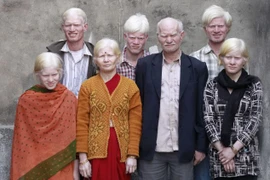 Kỷ lục 10 người mắc bệnh bạch tạng trong một gia đình.