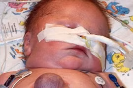 Ca đầu tiên trên thế giới sống sót với quả tim ngoài lồng ngực