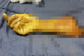 Nối thành công cánh tay bị đứt rời