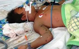 Hà Nội: Gần 50 học sinh tiểu học nhập viện cấp cứu vì ong đốt