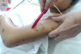 Vụ 52 học sinh bị ong đốt: Toàn bộ bệnh nhân đã ra viện 