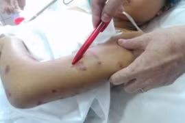 Vụ 52 học sinh bị ong đốt: Toàn bộ bệnh nhân đã ra viện 