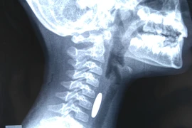 Nuốt đồ chơi, bé gái bị thủng thực quản suốt 2 năm mà không biết ​