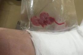 Để quên gạc trong chân bệnh nhân sau khi phẫu thuật, bác sĩ bị tạm đình chỉ